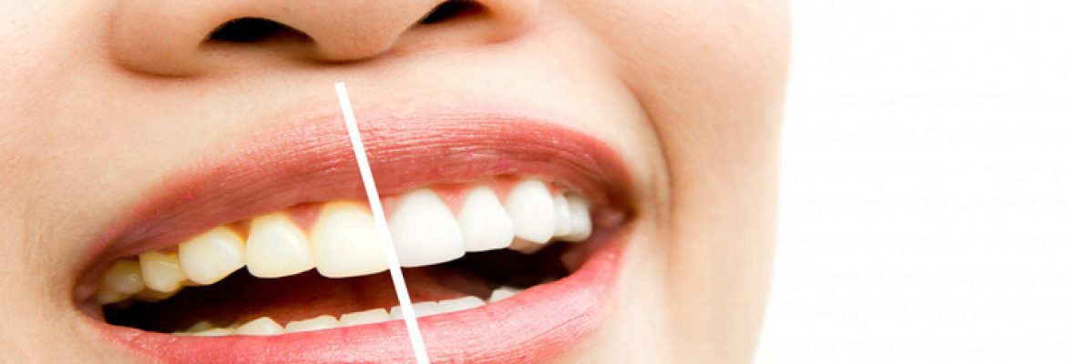 TOP 10 Remedies for Dental Plaque